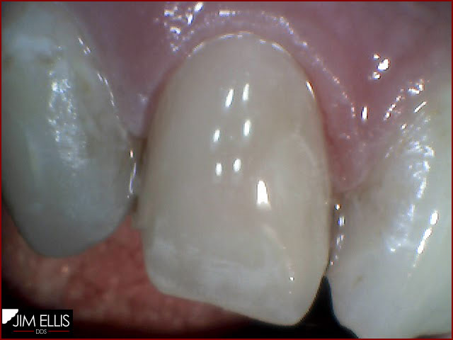 Ogden Dentist - 08292012: Front Teeth AFTER