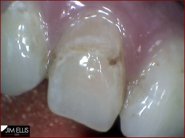Ogden Dentist - 08292012: Front Teeth BEFORE