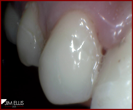 Ogden Dentist AFTER: Cavity removed and Dental Filling