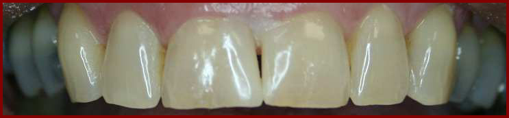 Front Teeth AFTER Closing the Gap