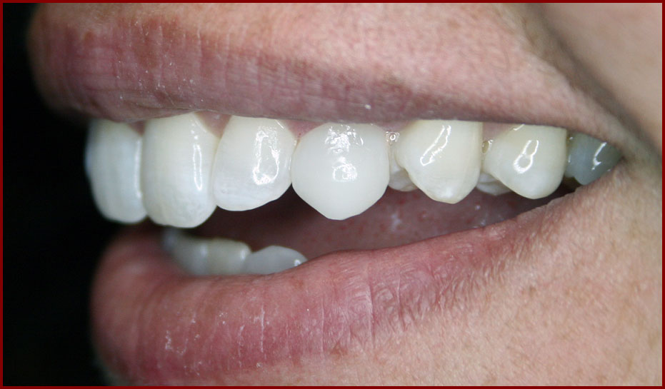 Cosmetic Dental Bonding Ms. E (AFTER)