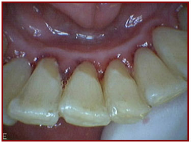Patient's Teeth AFTER Dental Cleaning
