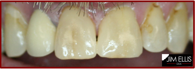 AFTER Closing Front Teeth Gap - Ogden Dentist
