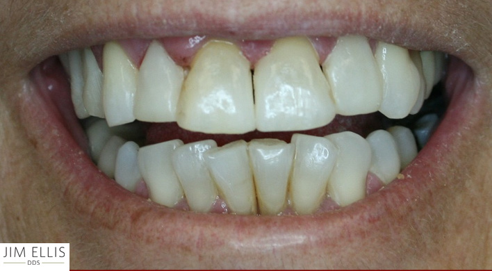 Ogden Dentist AFTER: Front Gap