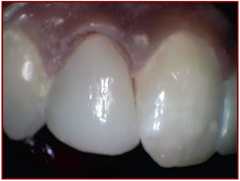 (AFTER) patient's teeth