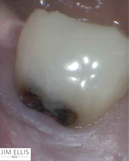 Ogden Dentist BEFORE: Tooth Black Spot