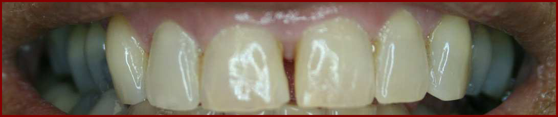 Front Teeth BEFORE Closing the Gap