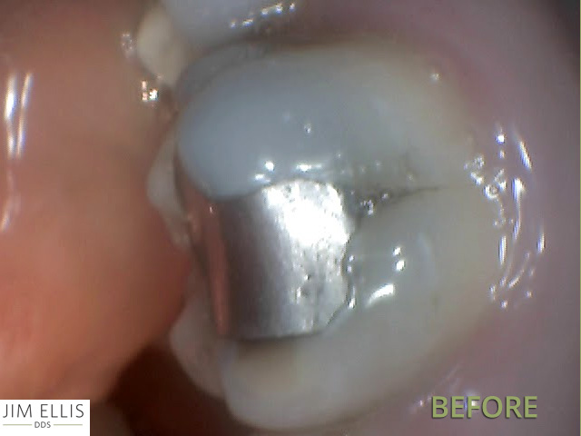Ogden Dentist BEFORE: Crack Metal Filling