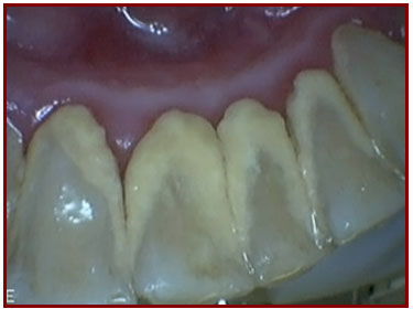 Patient's Teeth BEFORE Dental Cleaning