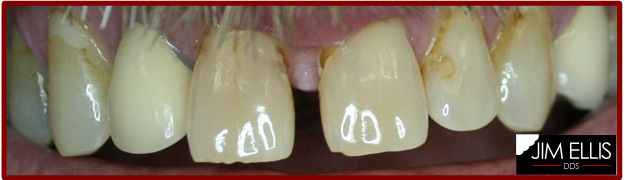 BEFORE Closing Front Teeth Gap - Ogden Dentist