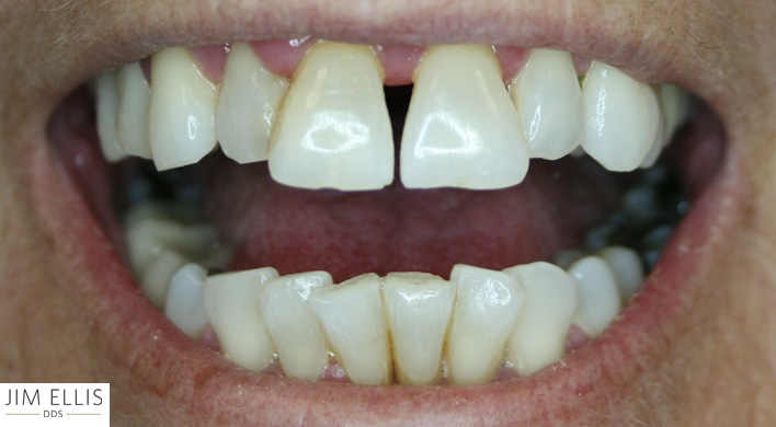 Ogden Dentist BEFORE: Front Gap