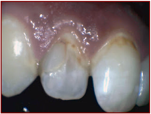 (BEFORE) patient's teeth