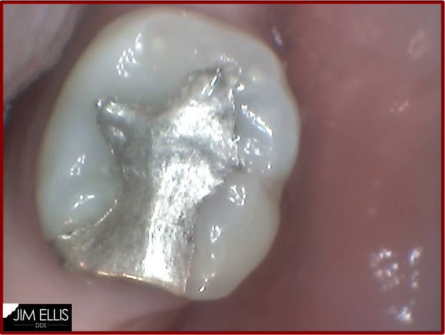 Before: Old Metal Filling - Ogden Dentist
