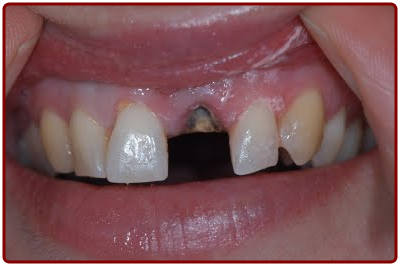 Broken Tooth - Ogden Dentist
