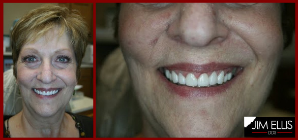 Ogden Dentist AFTER: Cosmetic Dental Makeover for Camille