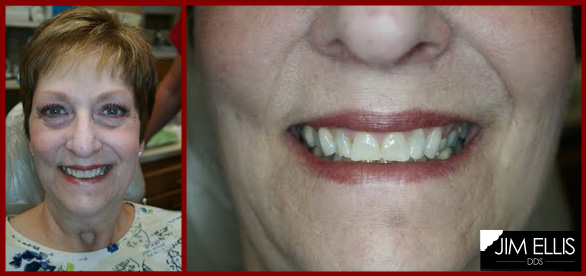 Ogden Dentist BEFORE: Cosmetic Dental Makeover for Camille