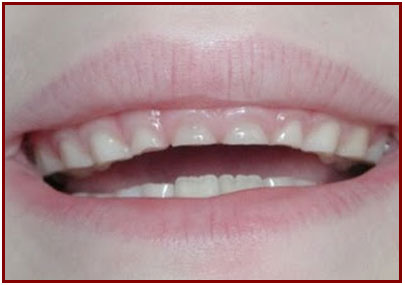 Child's Teeth - Ogden Dentist