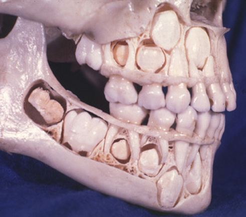Child’s Skull - Adult Teeth developing