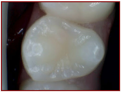 Ogden Dentist: Dental Filling Step 1
