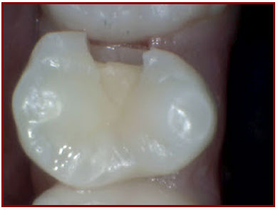 Ogden Dentist: Dental Filling Step 2