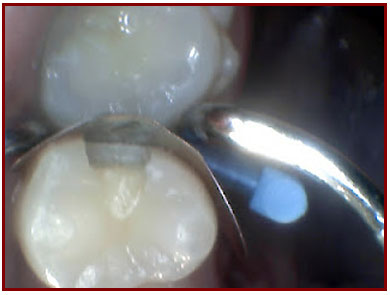 Ogden Dentist: Dental Filling Step 3