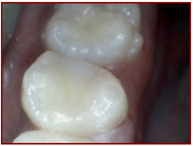 Ogden Dentist: Dental Filling Step 4