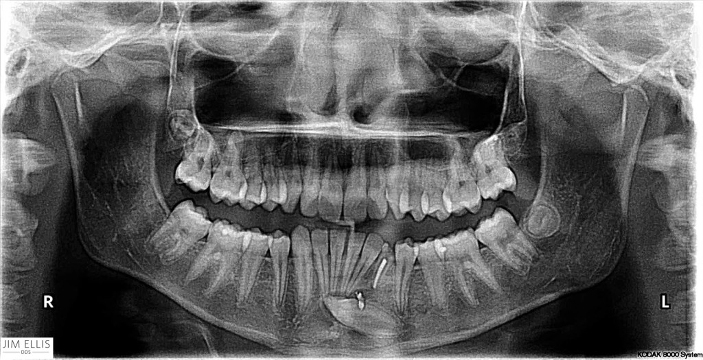 Dental x-ray 1