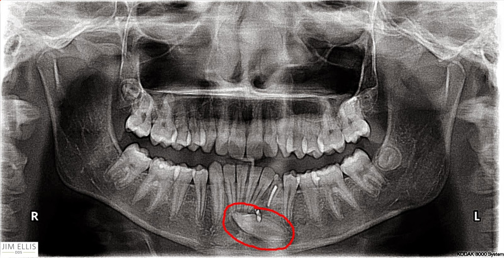 Dental x-ray 2