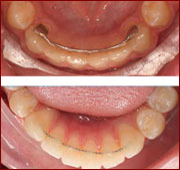 Differenta Retainers - Ogden Dentist