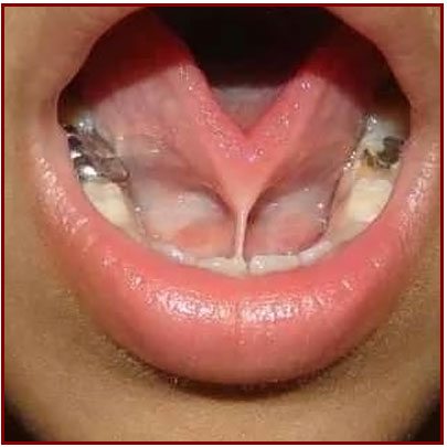 Frenulum of Tongue (photo 2)