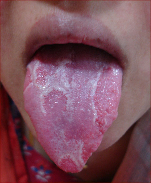 Geographic Tongue (real)