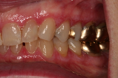Smile, Gold Dental Crowns