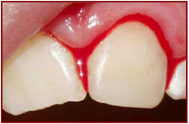 Gums bleeding - Ogden Dentist