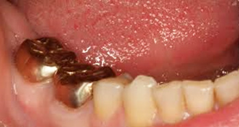 best-zirconia-crown-dentist-ogden-near-me
