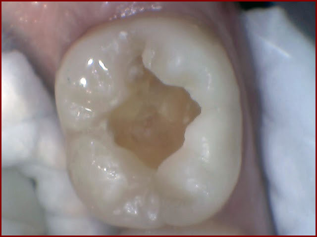 Mr. K's tooth without cavity
