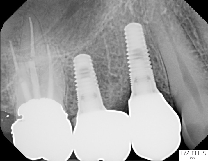 X-ray of Teeth in place