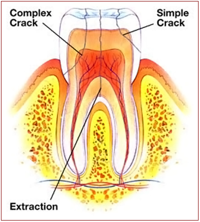 Tooth Cracks - Ogden Dentist