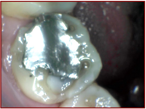Tooth has a large metal filling